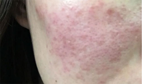 皮膚泛紅癢是什么原因？皮膚紅癢怎么回事？