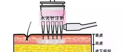 水光針的類型有哪幾種？