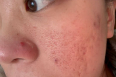 去痘印做什么醫(yī)美項目最好？