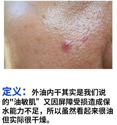油痘肌和油敏肌怎么區(qū)分？油痘肌和油敏肌的區(qū)別！