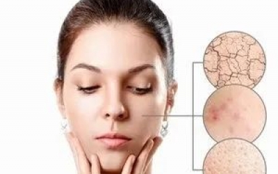 什么是春敏？如何預(yù)防春敏？