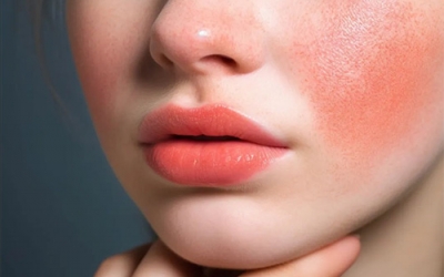 秋季皮膚為什么容易過敏？