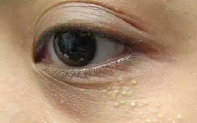 脂肪粒怎么樣才能去除？脂肪粒的去除方法！